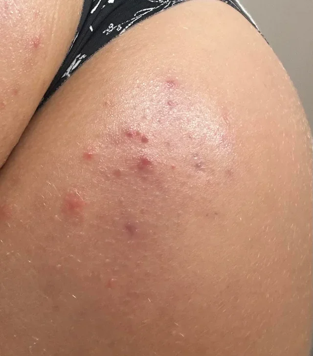 Acné corporal y foliculitis en glúteos, espalda y brazos con granitos rojos — Dr. Asian · Blondas Paraguay