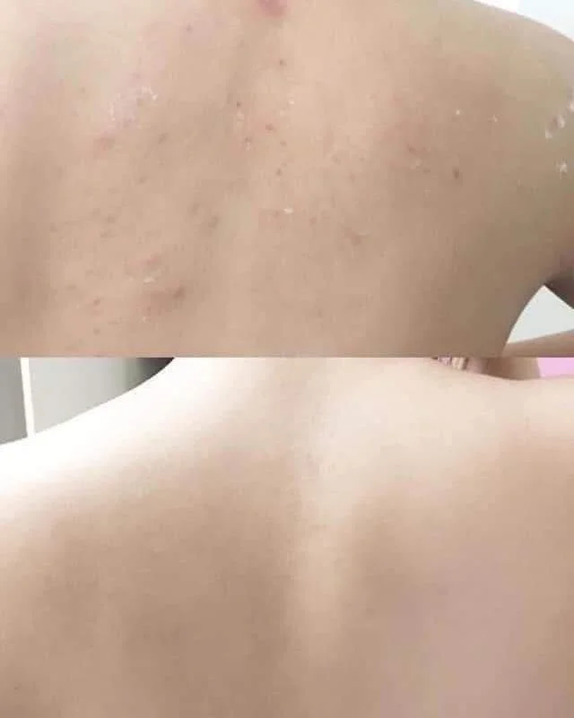 Antes y después de acné en la espalda: la piel se empareja con la rutina constante — Dr. Asian · Blondas Paraguay