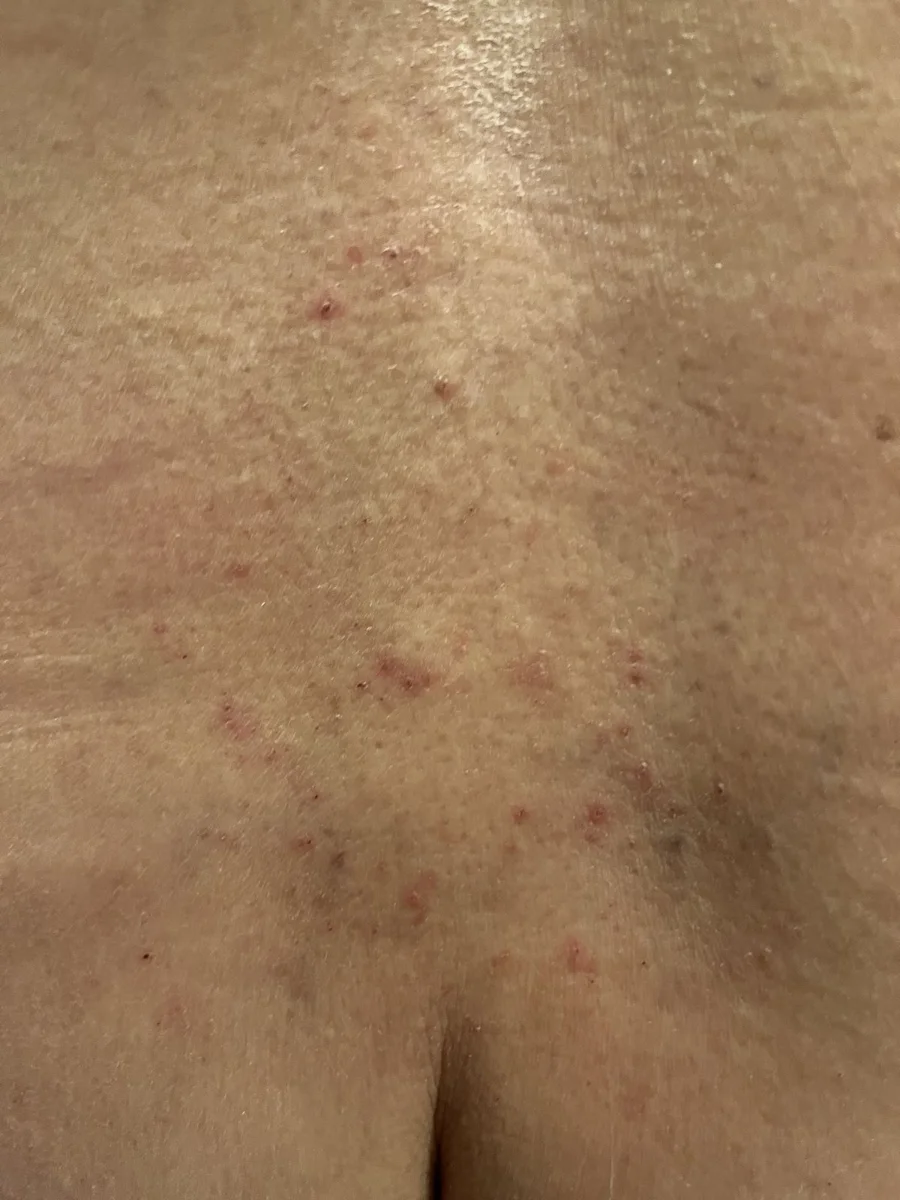 Bacne: granitos inflamados en la espalda que se tratan con ácido salicílico — Dr. Asian · Blondas Paraguay