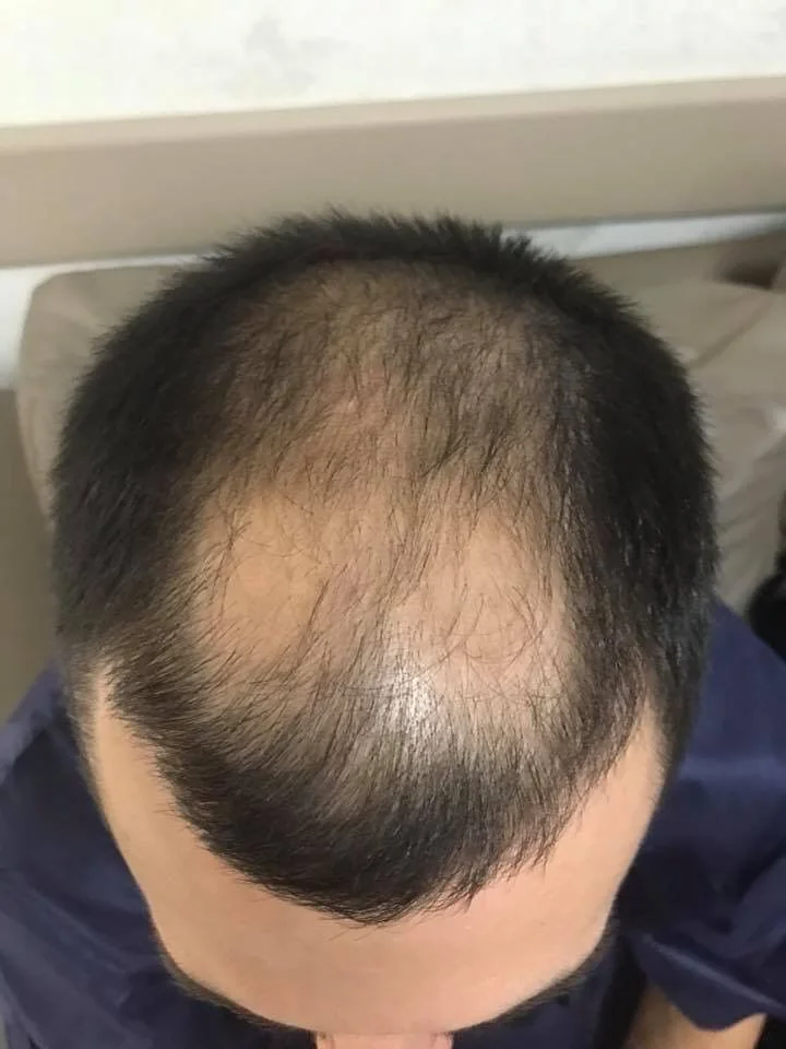 Coronilla afinada en hombres por caída difusa al bajar de peso — Dr. Asian · Blondas Paraguay