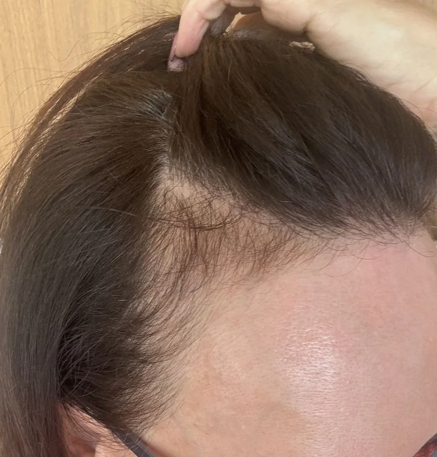 Cabello afinado en la zona frontal y las sienes por efluvio telógeno — Dr. Asian · Blondas Paraguay