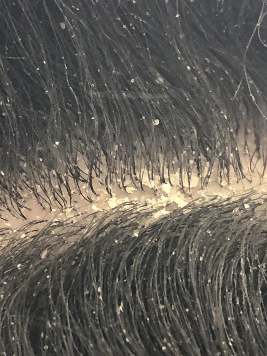 Descamación y escamas blancas en el cuero cabelludo por caspa — Dr. Asian · Blondas Paraguay