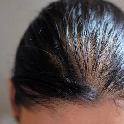 Cuero cabelludo graso en la raíz por seborrea — Dr. Asian · Blondas Paraguay