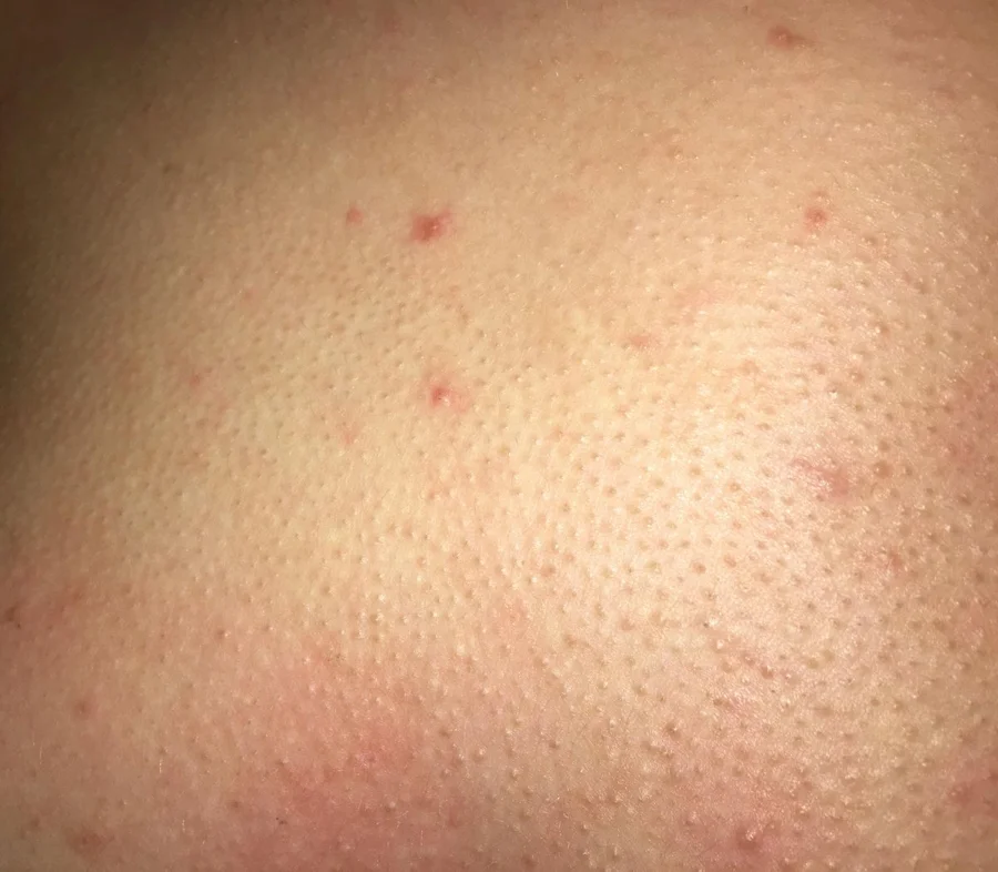 Foliculitis: bolitas y poros marcados en brazos y hombros — Dr. Asian · Blondas Paraguay