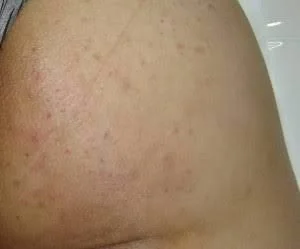 Manchas oscuras post-acné en glúteos y muslos que se emparejan con ácido glicólico — Dr. Asian · Blondas Paraguay