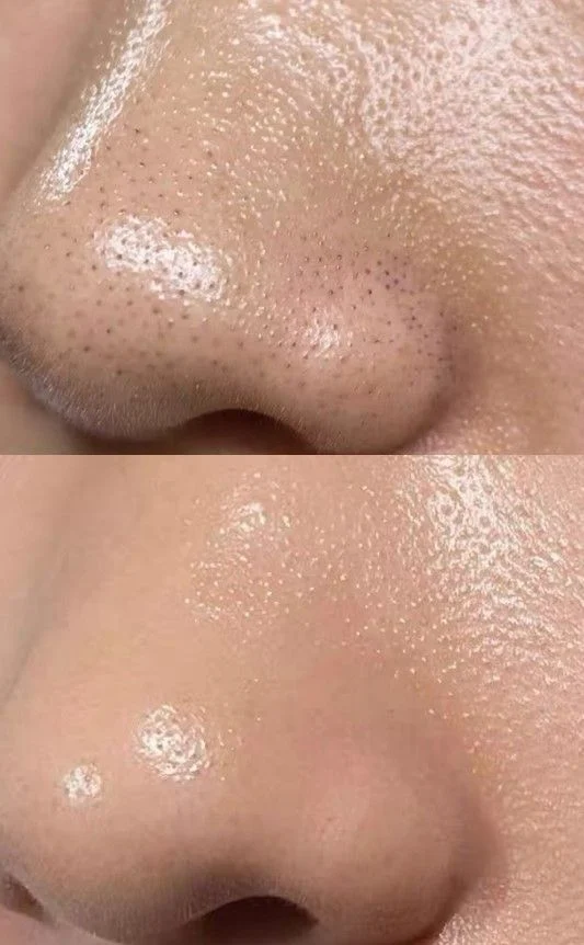 Nariz con puntos negros antes y la piel más limpia después de la rutina con salicílico — Dr. Asian · Blondas Paraguay