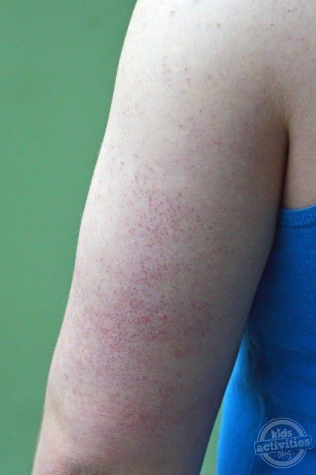 Bolitas rojas de queratosis pilaris en la parte de atrás del brazo — Dr. Asian · Blondas Paraguay