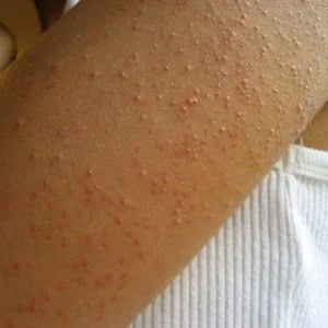 Queratosis pilaris: bolitas ásperas y rojas en el brazo (piel de gallina) — Dr. Asian · Blondas Paraguay