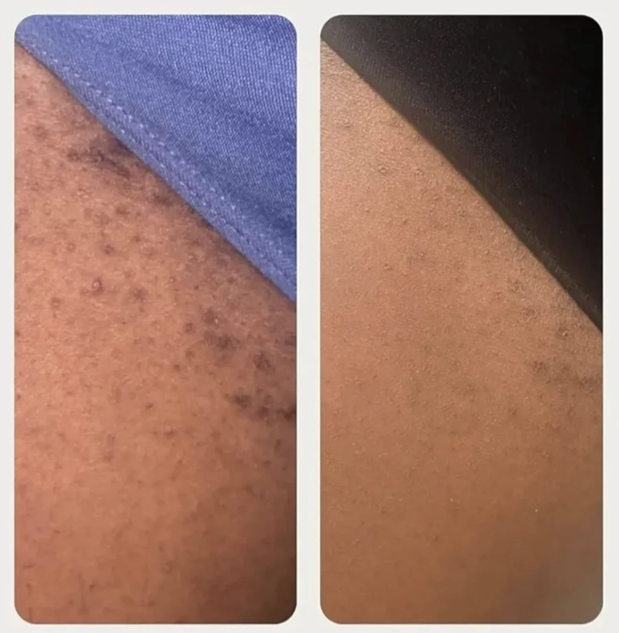 Antes y después: manchas oscuras por vellos encarnados que se emparejan con ácido glicólico — Dr. Asian · Blondas Paraguay