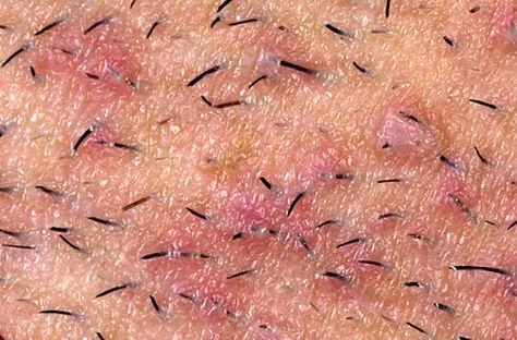 Vellos encarnados y pseudofoliculitis: bolitas rojas con un pelo atrapado — Dr. Asian · Blondas Paraguay
